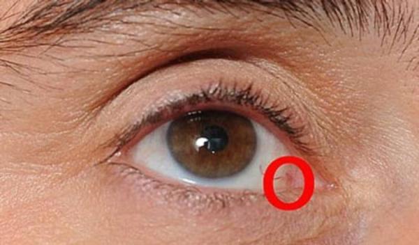 علائم سرطان چشم چیست و روش درمان آن چه می باشد؟
